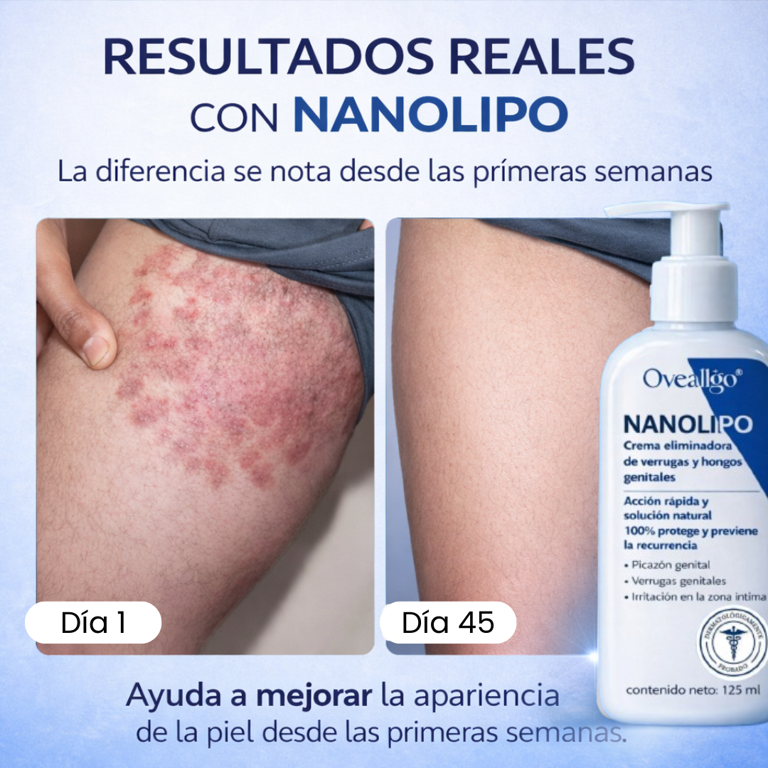 Crema eliminadora de hongos y verrugas genitales Oveallgo® Nanolipo
